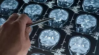 Yaşlı Erkeklerde Genetik Varyant Demans Riskini Artırıyor