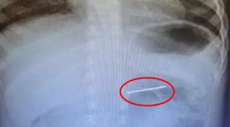 Bucak'ta 2 Yaşındaki Çocuk Çivi Yuttu, Endoskopi ile Çıkarıldı