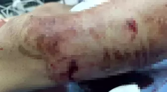 Yaylada Ayı Saldırısına Uğrayan 17 Yaşındaki Çocuk Hastaneye Kaldırıldı