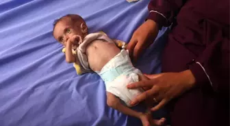Gazze'de Açlık ve Yetersiz Beslenmeden 15 Kişi Hayatını Kaybetti