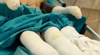 Orman Yangınında Yaralanan İşçi Kader Dereli'nin Tedavisi Devam Ediyor