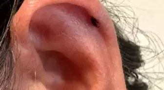 Adıyaman'da Kene Isırdı, Kadın Hastaneye Kaldırıldı