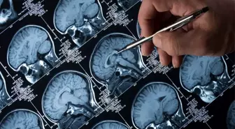 Lityum, Alzheimer'ın İlerlemesini Etkiliyor