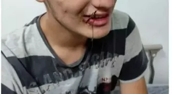 Balık Oltası İğnesi Ağızda Kaldı, İtfaiye Ekipleri Kurtardı