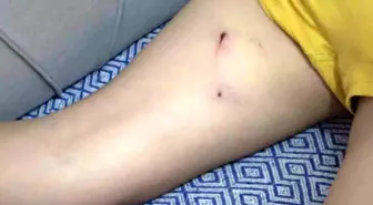 Rize'de 5 Yaşındaki Çocuk Sokak Köpeğinin Saldırısına Uğradı