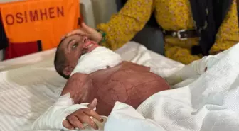 Mustafa'nın Yanık Tedavisiyle Hayata Tutunma Mücadelesi
