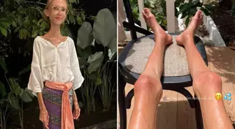 Meyve diyetiyle 20 kiloya kadar düşen sosyal medya fenomeni hayatını kaybetti