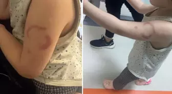 'Öğretmen, 3 yaşındaki çocuğun kolunu ısırdı' iddiası