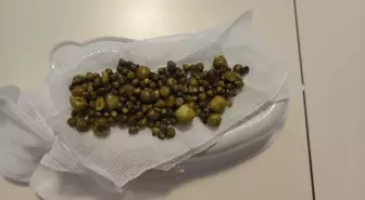 İnegöl'de 213 Safra Taşı Bulunan Kadın Başarıyla Ameliyat Edildi