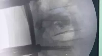 Kanuni Eğitim ve Araştırma Hastanesi'nde Başarıyla Omurga Ameliyatı Gerçekleştirildi