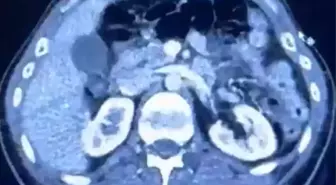 Ülkeye midelerinde uyuşturucu getiren şahıslar yakalandı