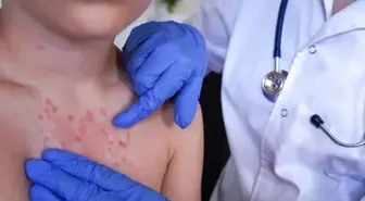 Vakalar pik yaptı! İki haftada ortaya çıkıyor, 3 yıl kadar sürüyor