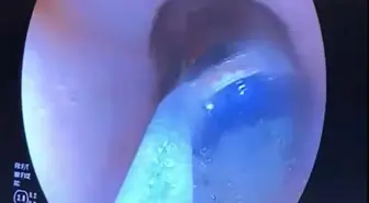 Midesindeki 9 pil, endoskopik yöntemle çıkarıldı