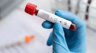 Dünyada vakalar azalıyor, Türkiye'de ise HIV artıyor