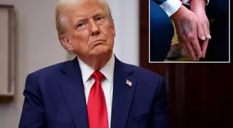 Trump elindeki morlukların nedenini ilk kez açıkladı