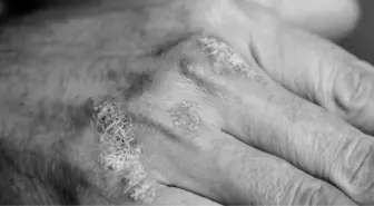 Egzama bulaşıcı mı? Egzama nedir, bulaşıcı mı, nasıl tedavi edilir?