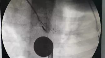 Siirt'te çocuğun boğazına kaçan madeni para müdahaleyle çıkarıldı