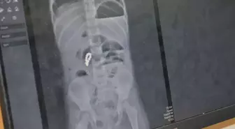 Mıknatıslı boncuklar bağırsaklarını delip tıkadı, 4 yaşındaki kız 8 adet mıknatıs çıkarıldı