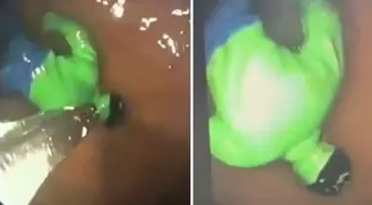 Hindistan'da çocuğun midesinden 'hulk' çıktı