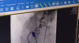 Hastanın kalbine giden kanı akciğere yönlendiren 'anormal damar' operasyonla kapatıldı