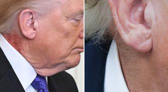 Trump'ın boynundaki kızarıklığı gizleme çabası