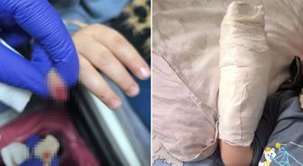 AVM'de yürüyen merdivene eli sıkışan çocuğun parmağı koptu