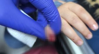 AVM'de yürüyen merdivene eli sıkışan çocuğun parmağı koptu