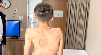 Kırgızistanlı genç şifayı Türk hekimlerinde buldu