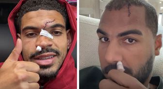 Kafa kafaya çarpışan Morgan Gibbs-White ve Robert Sanchez'in yüzünün son durumu korkuttu