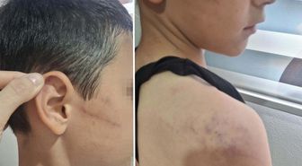 Babasının, öğretmeninden harçlık istedi diye darbettiği çocuk, devlet korumasına alındı