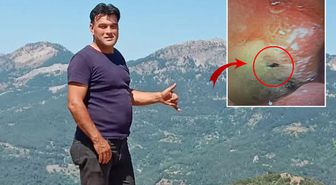 Kabus gibi olay! Midesinden canlı böcek çıkarıldı
