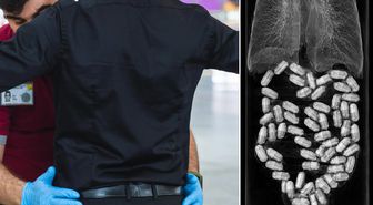 Midesinden 50 kapsül uyuşturucu çıktı