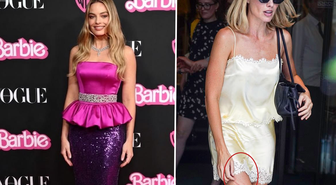 Barbie yıldızı Margot Robbie'nin bacağındaki morluk hayranlarını endişelendirdi