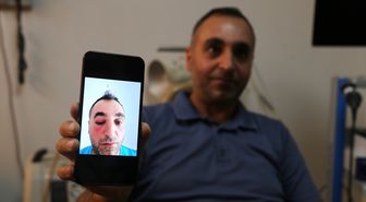 Bitlis'te kapalı yöntemle gözyaşı kanalı ameliyatı