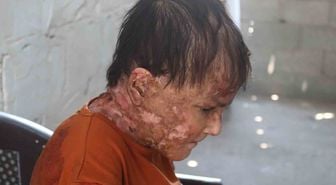 Gazze'de Kelebek Hastası Genç Kadın Acil Tahliye Çağrısı Yaptı