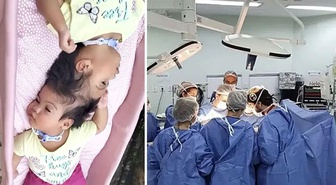 Yapışık ikizlerden acı haber: Kalpleri 14 dakika arayla durdu