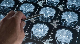 Derin Uyku Beyin Dalgaları Alzheimer'a Karşı Koruma Sağlayabilir