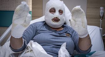 Ardahan'da kızını yangından kurtarırken ağır yaralanan annenin tedavisi sürüyor
