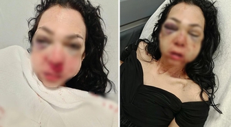 Bayram günü kadının yüzünü bardak ve kül tablasıyla kırmıştı: Tutuklandı