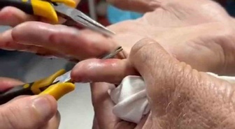 Batman'da yaşlı adamın parmağına sıkışan yüzük acil serviste çıkarıldı