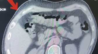 Tatvan'da otobüste yolcunun mide ve bağırsaklarında 608 gram metamfetamin bulundu