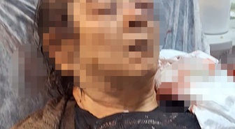 Kayseri'de evinde otururken tavan sıvası üzerine çöktü! 75 yaşındaki kadının sol gözünde ciddi görme kaybı