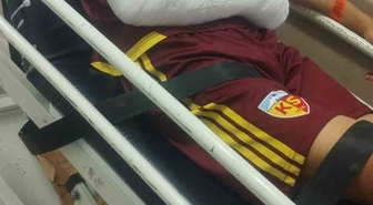 Kayserispor U19 oyuncusu Hilmi Türkan kolu kırılınca 2-3 ay sahalardan uzak kalacak