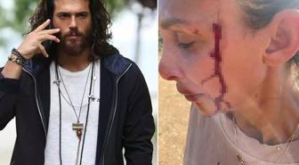 Can Yaman'ın sevgilisi Sara Bluma şiddet gördüğünü açıkladı