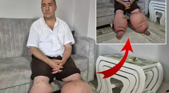 Yüksek ateş şikayetiyle hastaneye gitti, 15 yıldır 'fil hastalığı' ile mücadele ediyor