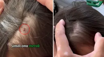 Baba, kızının kafasına yapışan keneyi böyle kopardı