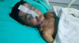 Salatalık yutunca öksürmeye başlayan çocuğun vücudunda kateter unutulduğu ortaya çıktı