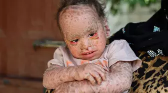 Balık pulu ve kelebek hastası Yusuf'un fotoğraflarını çalıp dolandırıcılık yaptılar