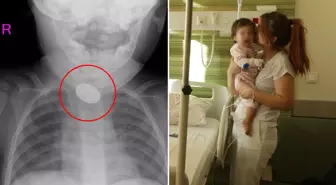 Kardeşi fark etti, hastaneye koştular! 15 aylık bebeğin yemek borusundan çıkanlar şoke etti