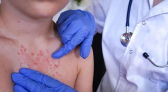 Vakalar son 30 yılda pik yaptı! İki haftada ortaya çıkıyor, 3 yıl kadar sürüyor